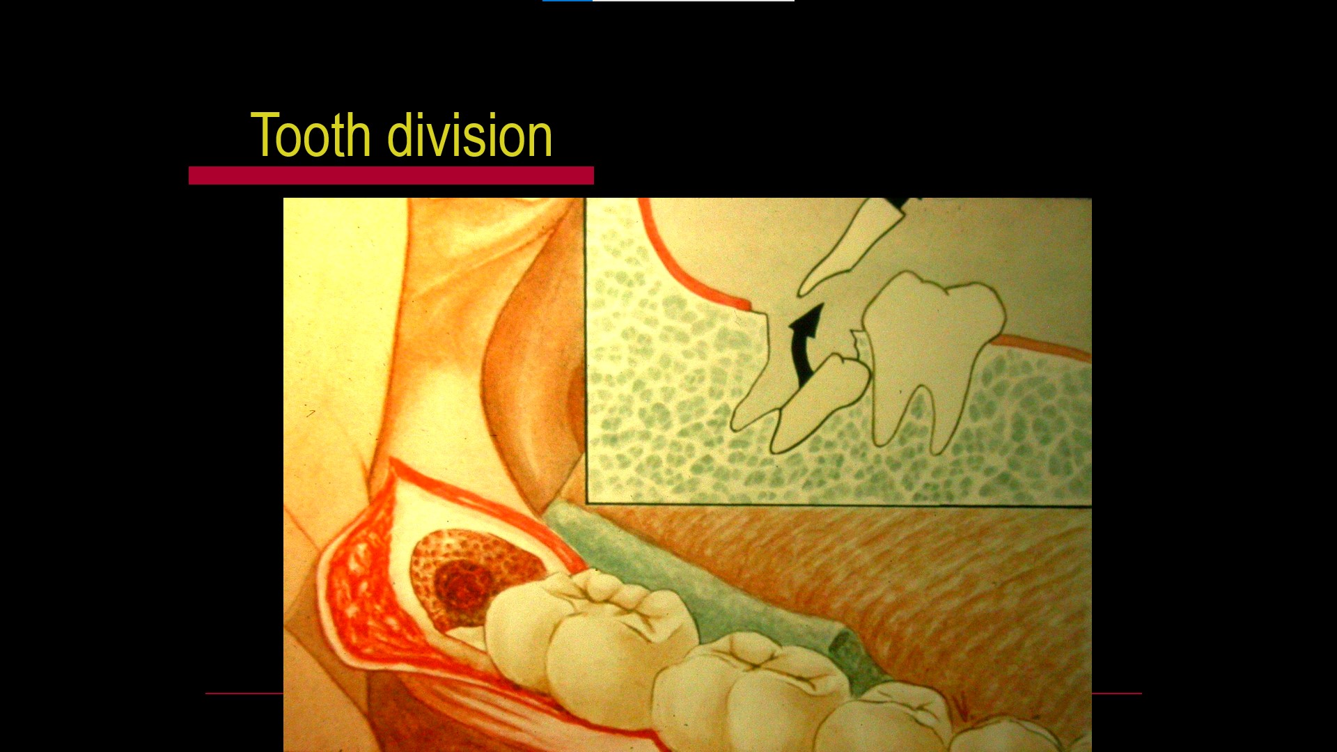 Impacted teeth4