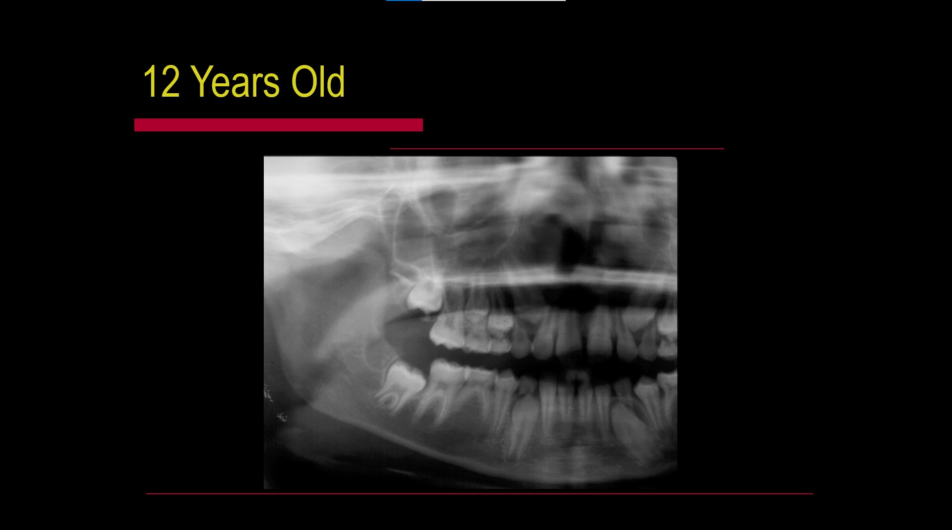 Impacted teeth1