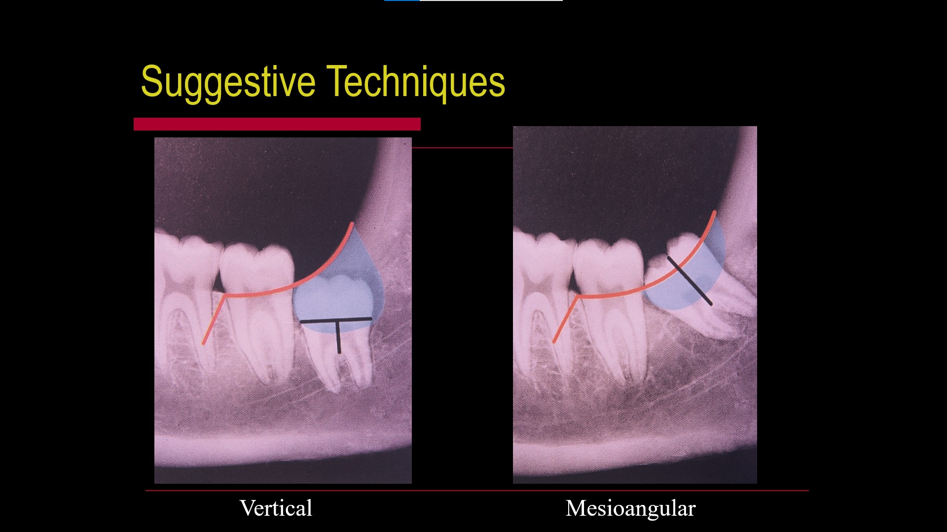 Impacted teeth4