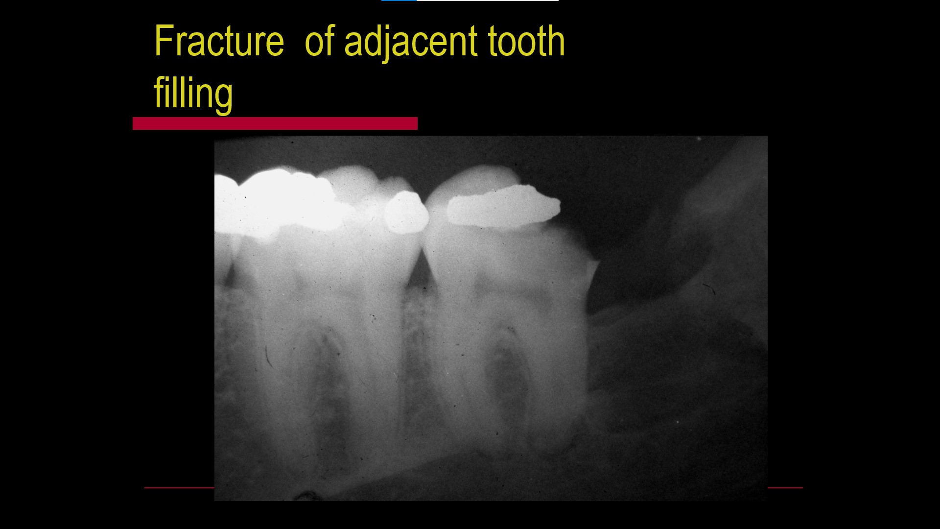 Impacted teeth4