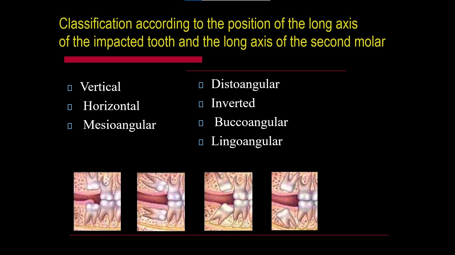 Impacted teeth4