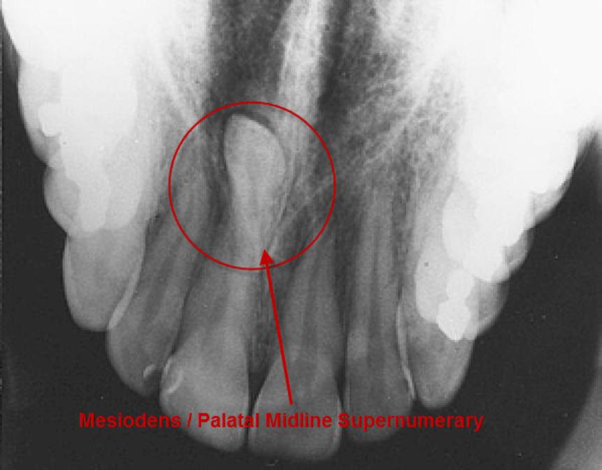 Ectopic & Supernumerary Tooth Removal Warnings4