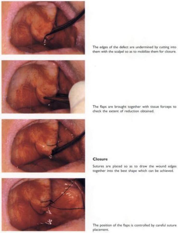 Reduction of Hyperplastic Tuberosities21